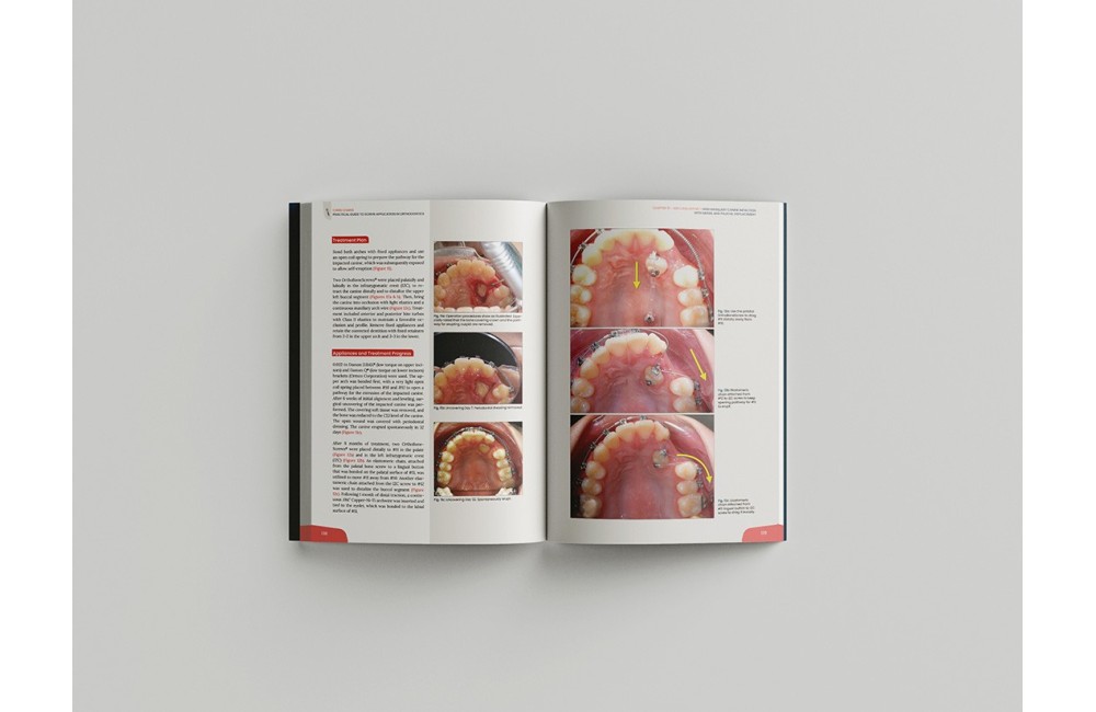 Miniscrew applications in orthodontics