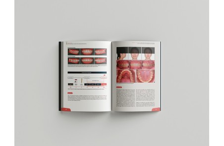 Miniscrew applications in orthodontics