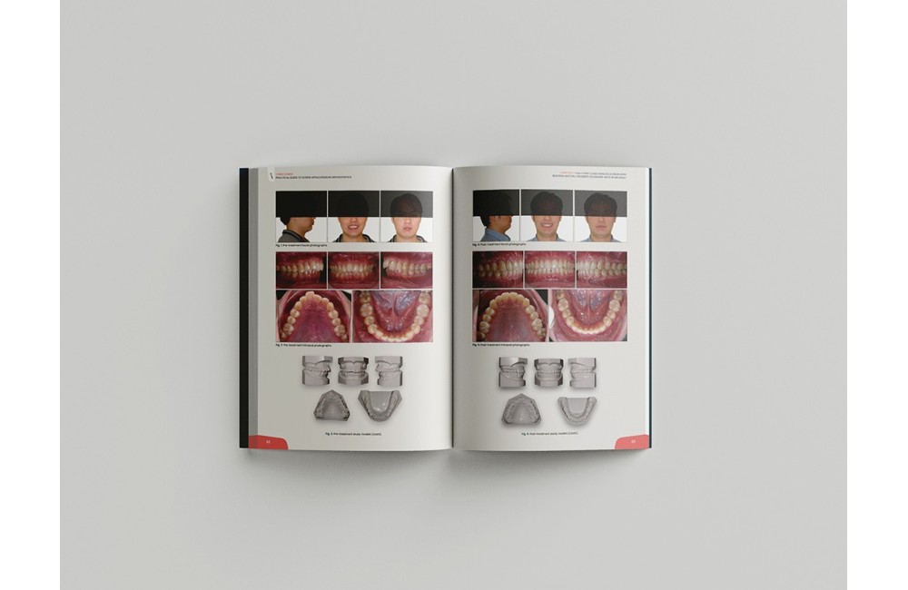 Miniscrew applications in orthodontics