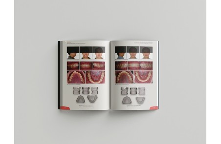 Miniscrew applications in orthodontics