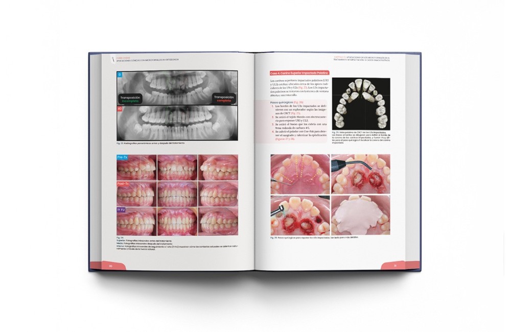 Minitornillos. Aplicaciones clínicas en ortodoncia