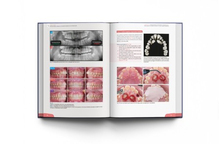 Minitornillos. Aplicaciones clínicas en ortodoncia