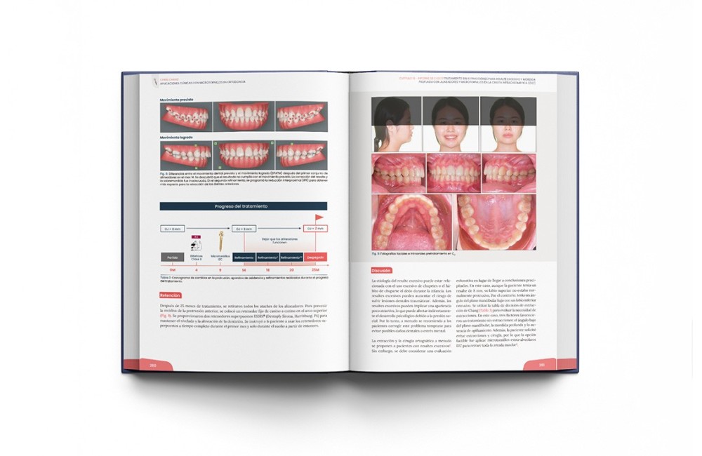 Minitornillos. Aplicaciones clínicas en ortodoncia
