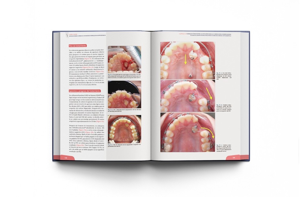 Minitornillos. Aplicaciones clínicas en ortodoncia