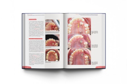 Minitornillos. Aplicaciones clínicas en ortodoncia