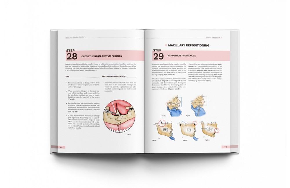 Orthognathic Surgery. Techniques, tips & tricks.