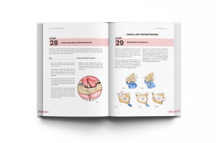 Orthognathic Surgery. Techniques, tips & tricks.