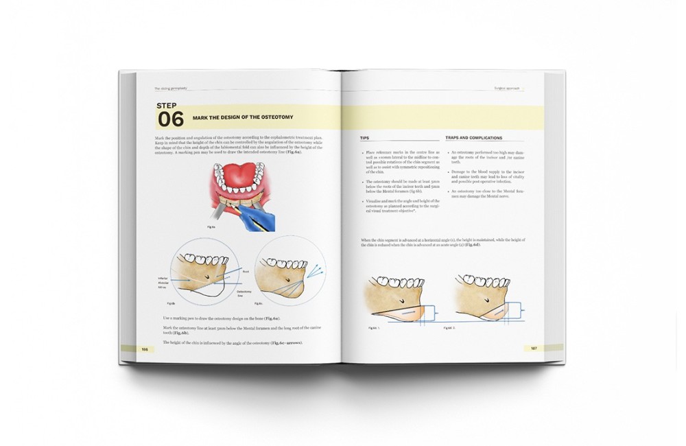 Orthognathic Surgery. Techniques, tips & tricks.