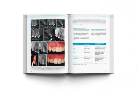 ENDODONCIA. Alteraciones morfológicas congénitas y adquiridas que la complican