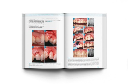 ENDODONCIA. Alteraciones morfológicas congénitas y adquiridas que la complican