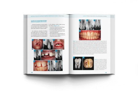 ENDODONCIA. Alteraciones morfológicas congénitas y adquiridas que la complican