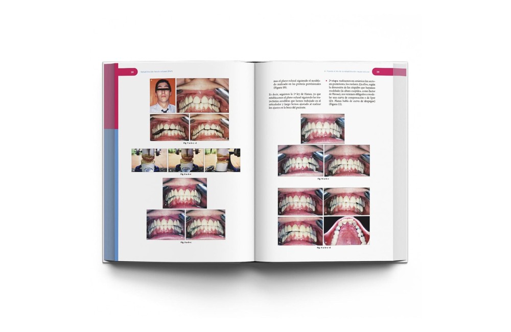 Rehabilitación Neuro-Oclusal (RNO)