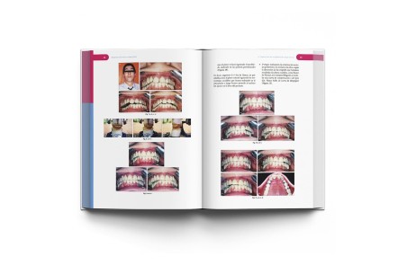 Rehabilitación Neuro-Oclusal (RNO)