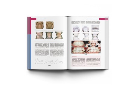 Rehabilitación Neuro-Oclusal (RNO)