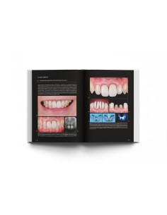 La preparación dental. Preparación de dientes para el éxito de las restauraciones. Jun Iwata - Lisermed 2