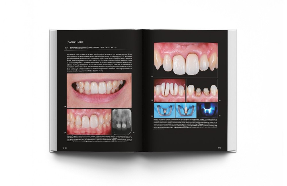 La preparación dental. Preparación de dientes...