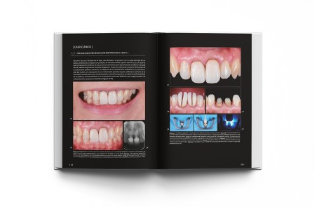 La preparación dental. Preparación de dientes para el éxito de las restauraciones