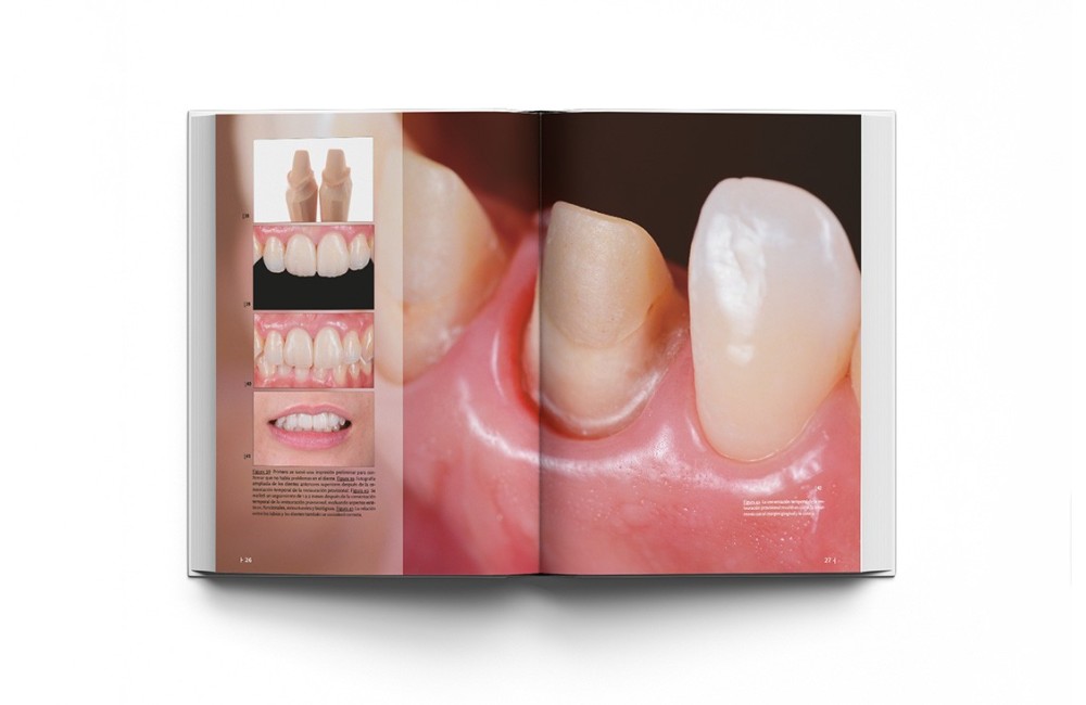 La preparación dental. Preparación de dientes...