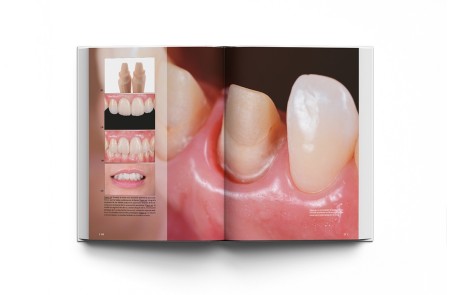 La preparación dental. Preparación de dientes para el éxito de las restauraciones