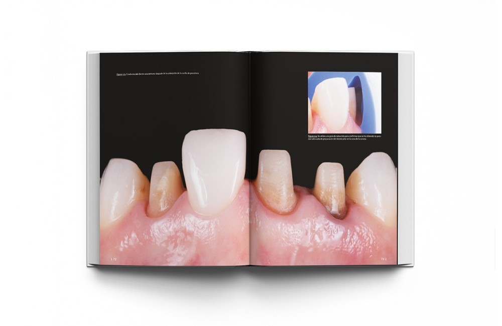 La preparación dental. Preparación de dientes...