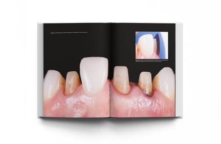 La preparación dental. Preparación de dientes para el éxito de las restauraciones