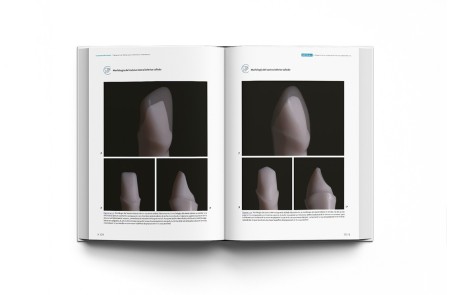 La preparación dental. Preparación de dientes para el éxito de las restauraciones