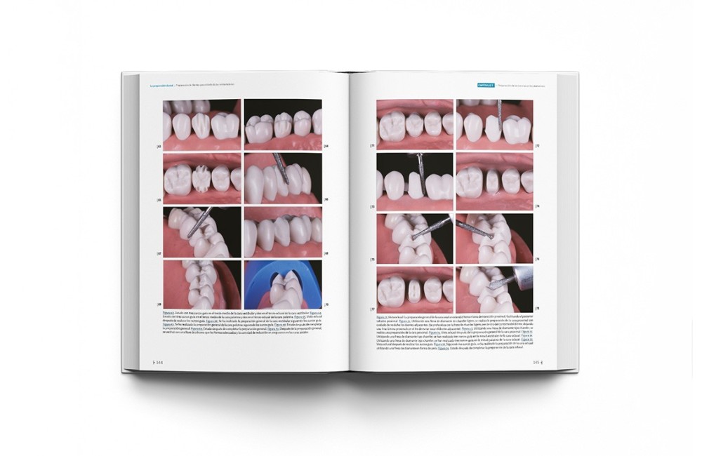 La preparación dental. Preparación de dientes...