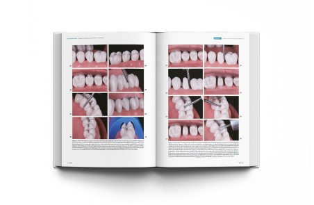 La preparación dental. Preparación de dientes para el éxito de las restauraciones