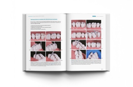 La preparación dental. Preparación de dientes para el éxito de las restauraciones