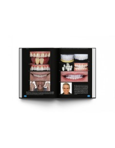 Rehabilitación Oral Estética con Carillas. Richard D. Trushkowsky - Lisermed 2