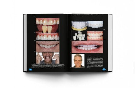 Rehabilitación Oral Estética con Carillas: Guía de Preparación del Tratamiento y Conceptos Clínicos