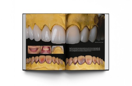 Rehabilitación Oral Estética con Carillas: Guía de Preparación del Tratamiento y Conceptos Clínicos