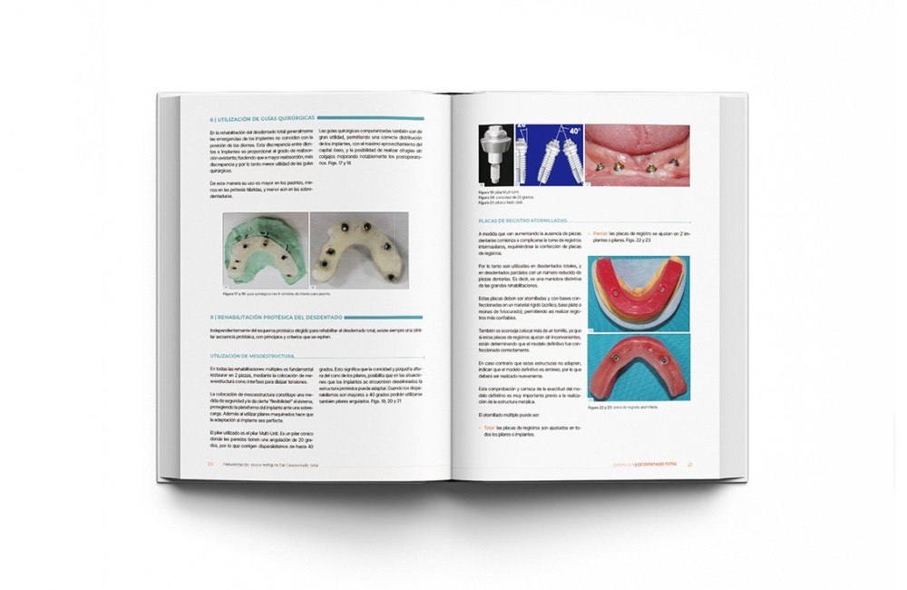 Rehabilitación Implantológica del Desdentado...