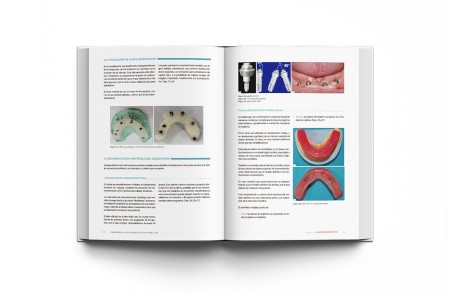 Rehabilitación Implantológica del Desdentado Total: Protocolo y Tratamiento Clínico