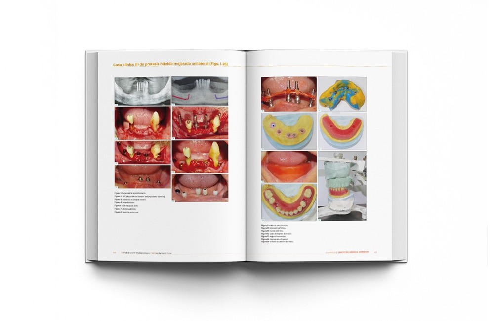 Rehabilitación Implantológica del Desdentado...