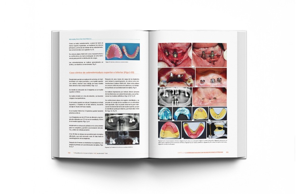 Rehabilitación Implantológica del Desdentado...