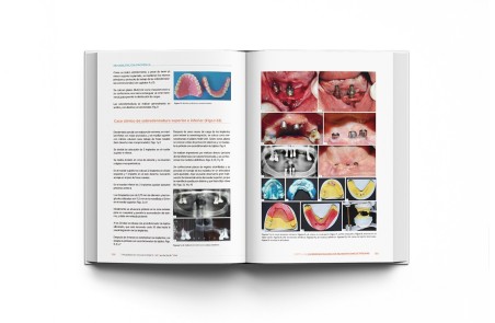 Rehabilitación Implantológica del Desdentado Total: Protocolo y Tratamiento Clínico