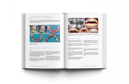 Rehabilitación Implantológica del Desdentado Total: Protocolo y Tratamiento Clínico