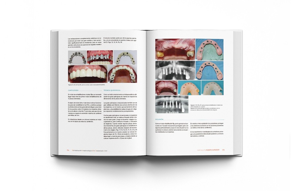 Rehabilitación Implantológica del Desdentado...