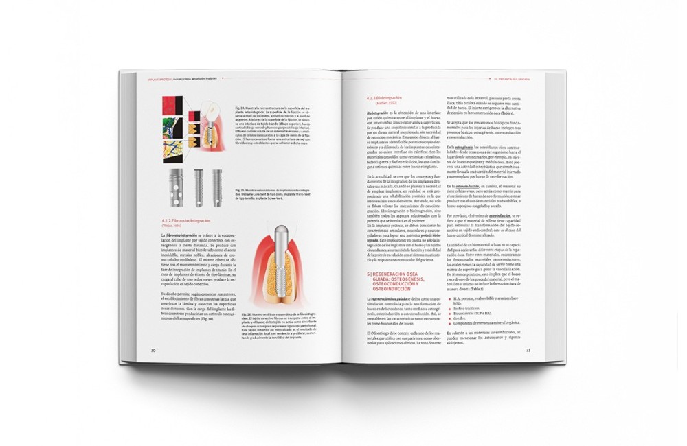 Implantoprótesis. Guía de Prótesis Dental Sobre...