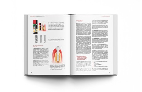 Implantoprótesis. Guía de Prótesis Dental Sobre Implantes