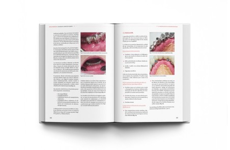 Implantoprótesis. Guía de Prótesis Dental Sobre Implantes