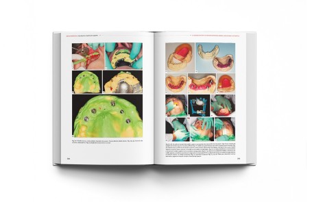 Implantoprótesis. Guía de Prótesis Dental Sobre Implantes