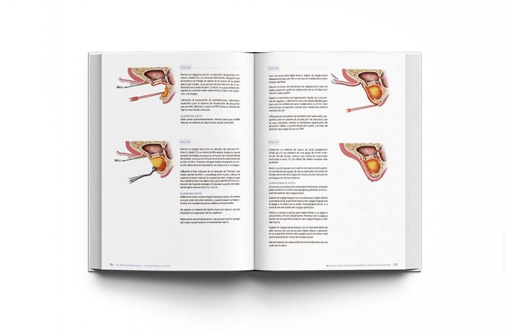 Principios de Regeneración de Tejidos Duros y...