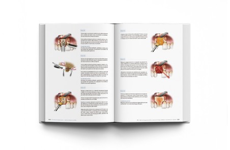 Principios de Regeneración de Tejidos Duros y Terapia de Implantes