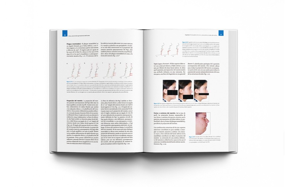 Arte y Ciencia de la Genioplastia Deslizante