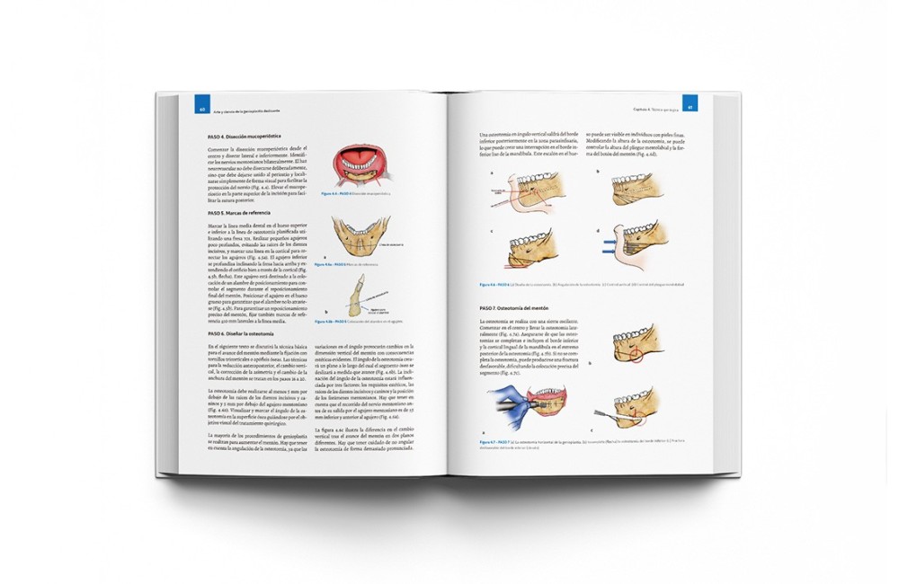 Arte y Ciencia de la Genioplastia Deslizante