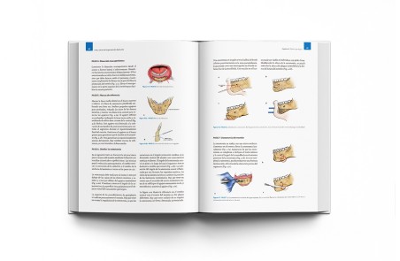 Arte y Ciencia de la Genioplastia Deslizante