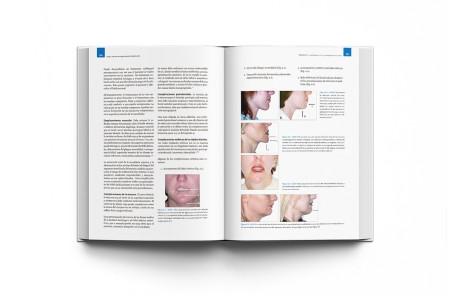 Arte y Ciencia de la Genioplastia Deslizante