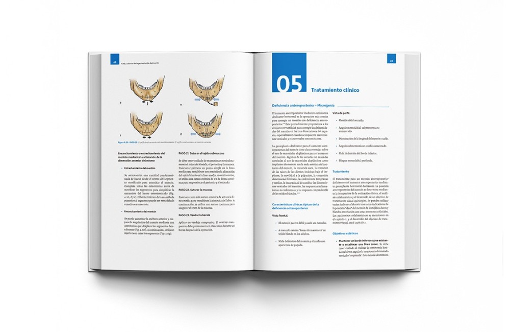 Arte y Ciencia de la Genioplastia Deslizante